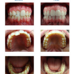 Teenager Invisalign, Crossbite photo, Clear braces, Fairfax, Virginia Dentist, Fair Oaks Dental Care