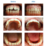 Fairfax, Fair Oaks Dental Care, Invisalign, Dentist,Front Tooth, Gap Closure, Clear braces, Orthodontics